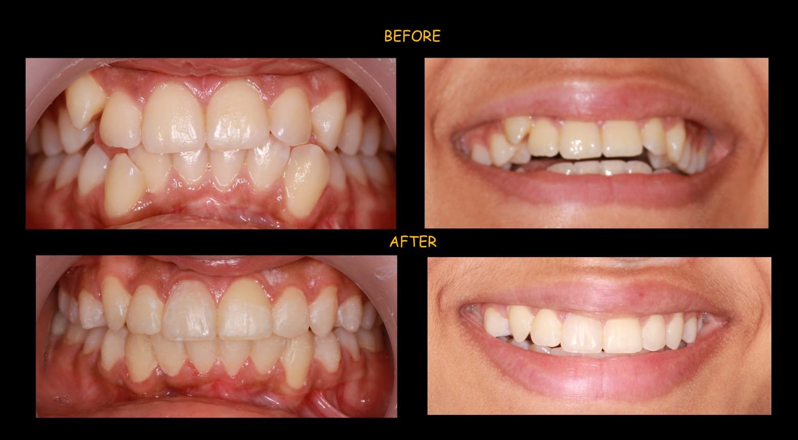 Clear aligners before and after