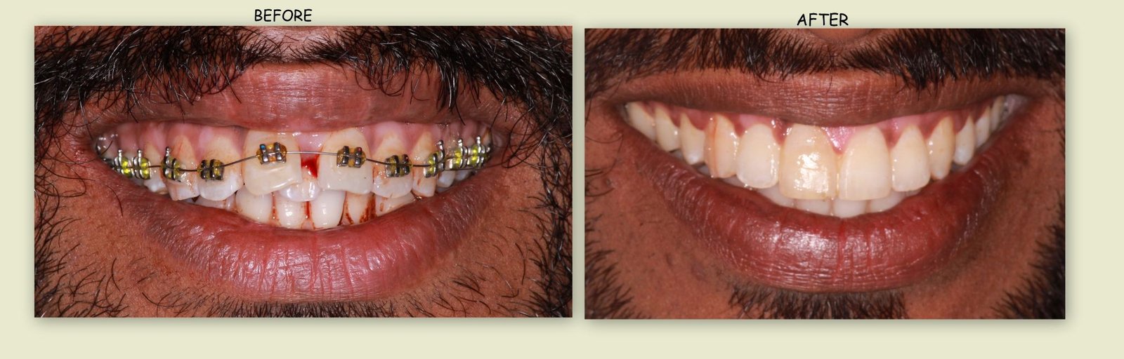 Clear aligners before and after