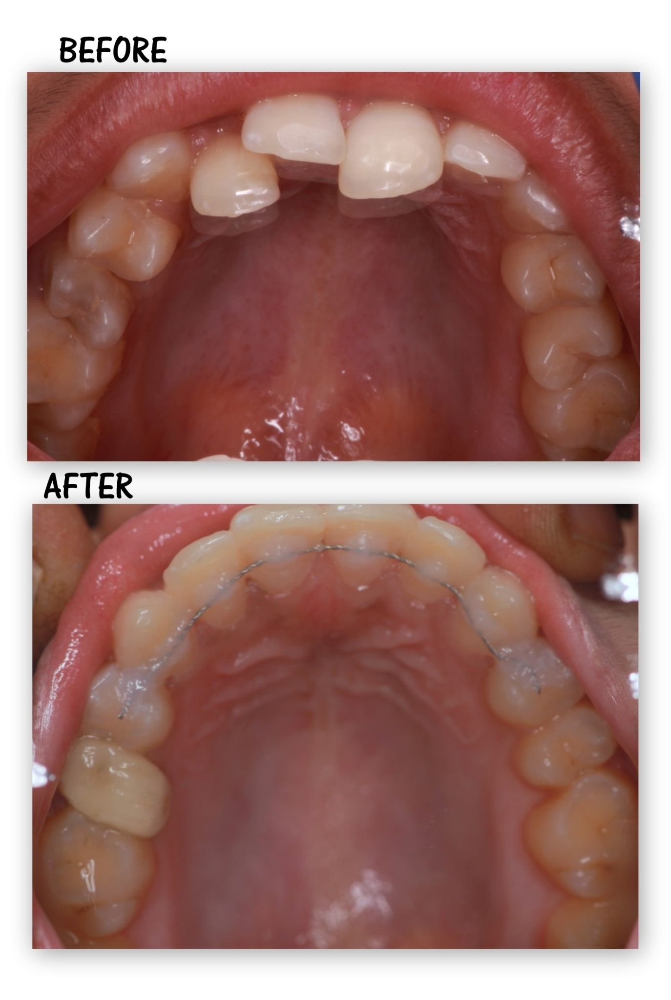 Clear aligners before and after