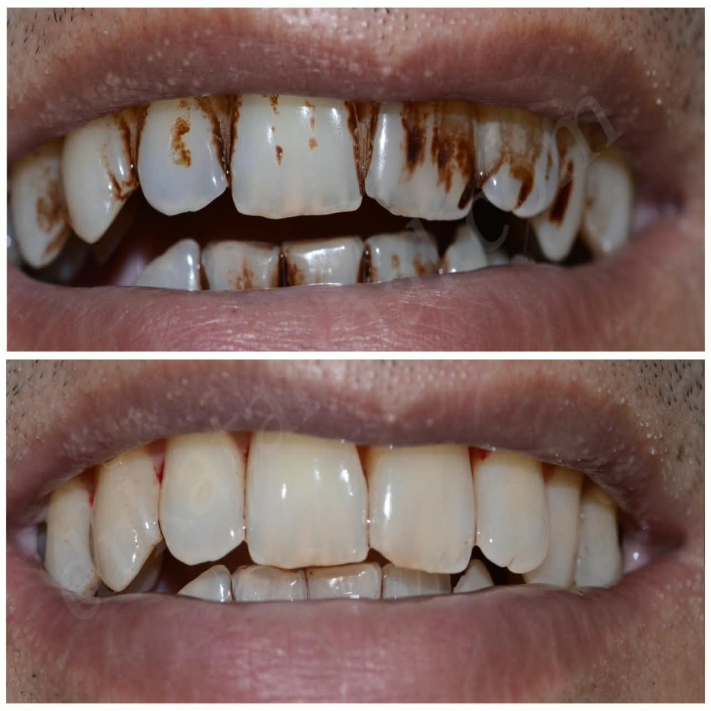 Teeth cleaning before and after