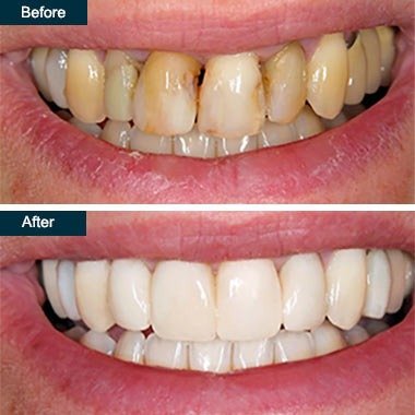 Teeth cleaning before and after