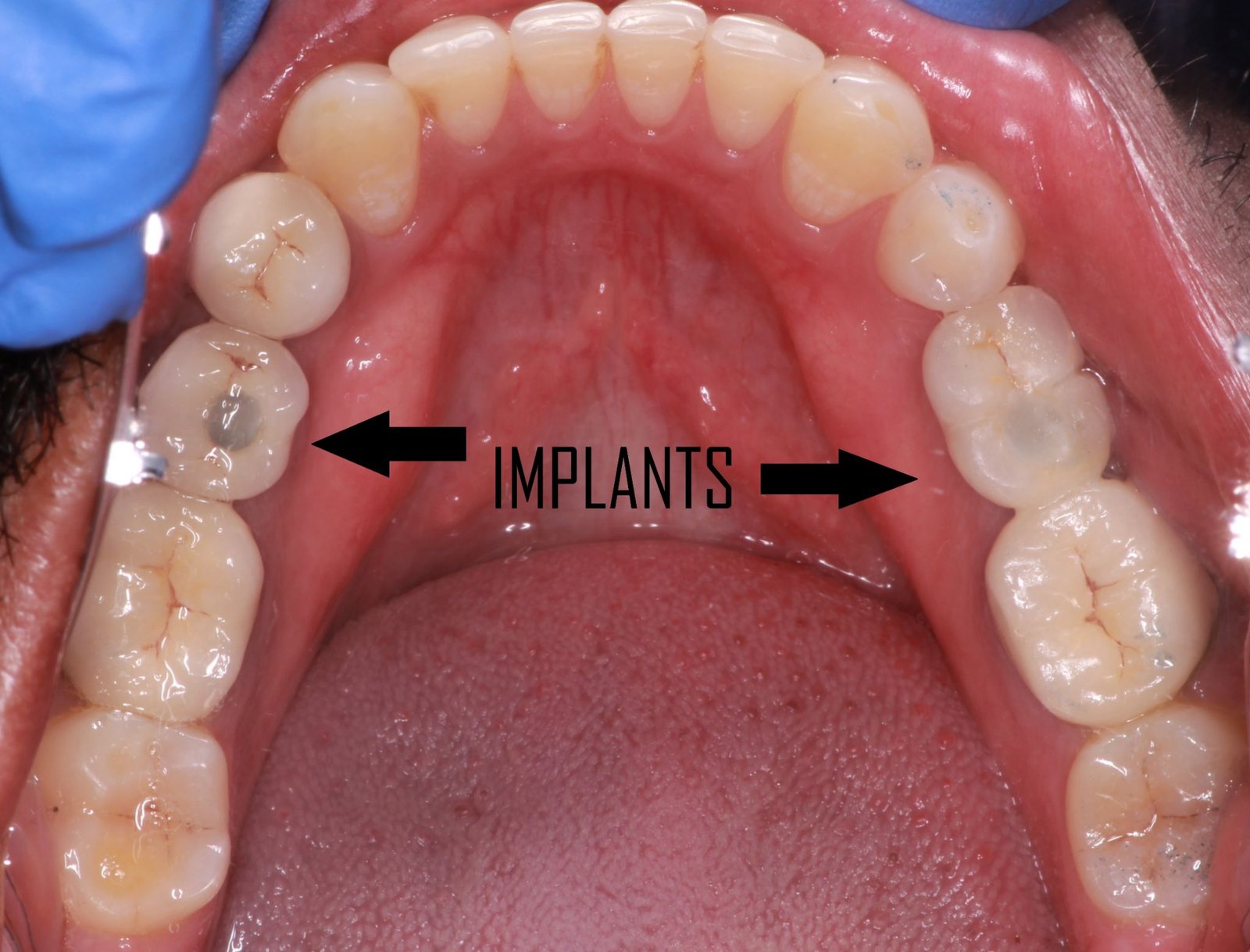 Dental implants treatment 1