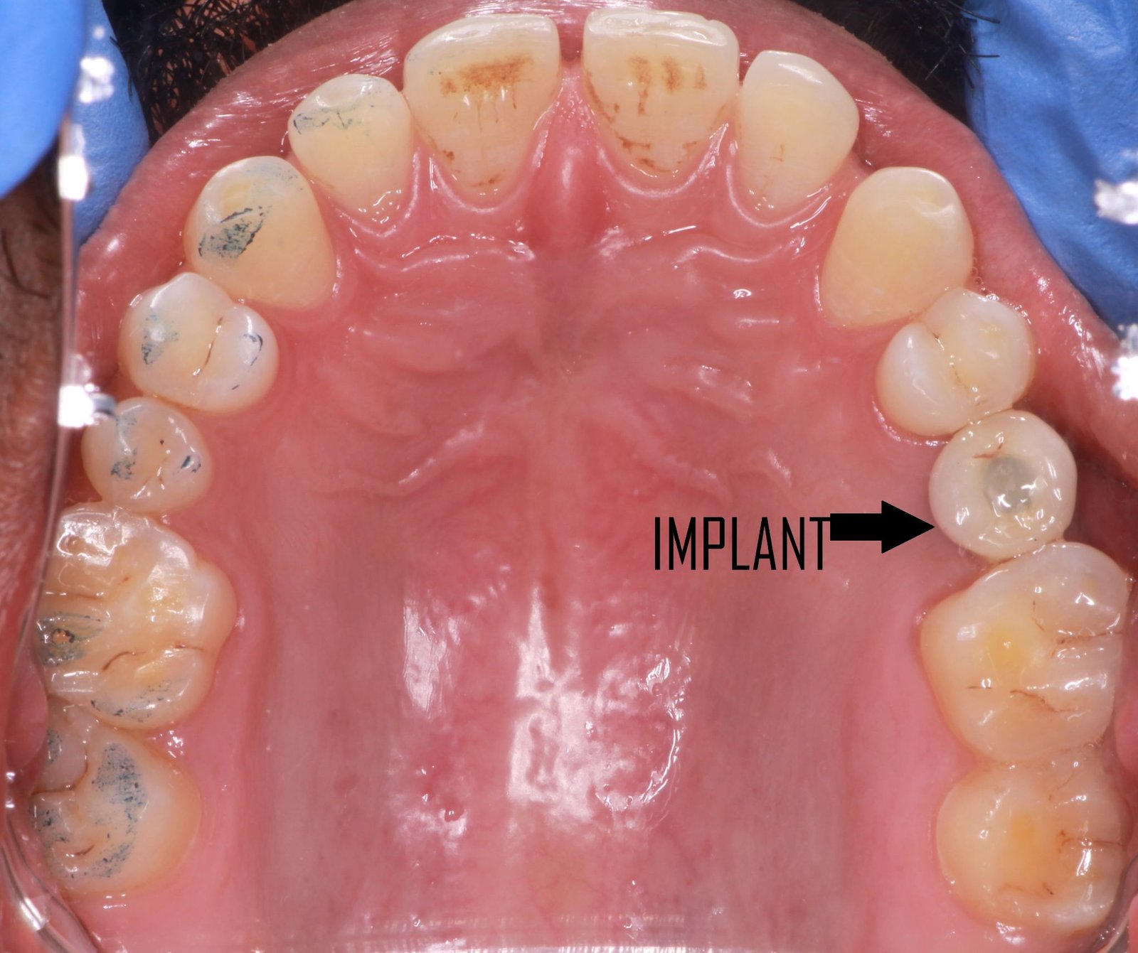 Dental implants treatment 2