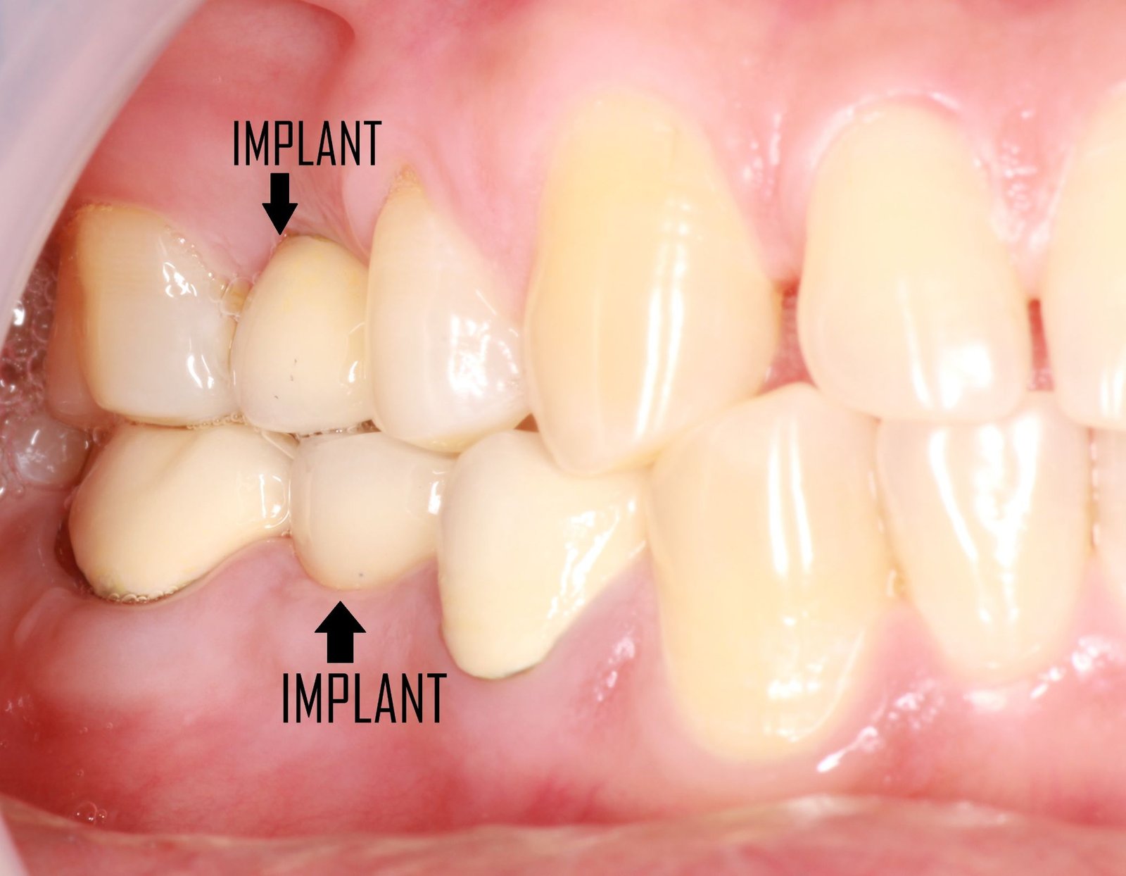 Dental implants treatment 3
