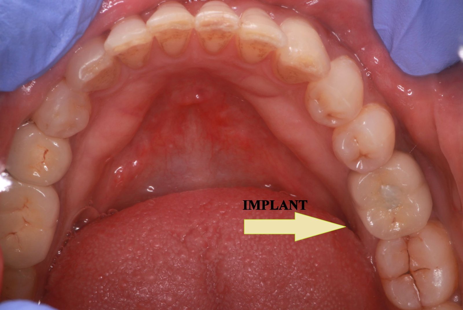 Dental implants treatment 4