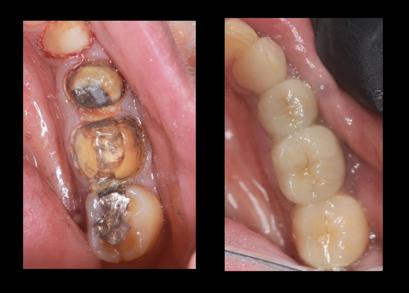 Dental implants treatment 5