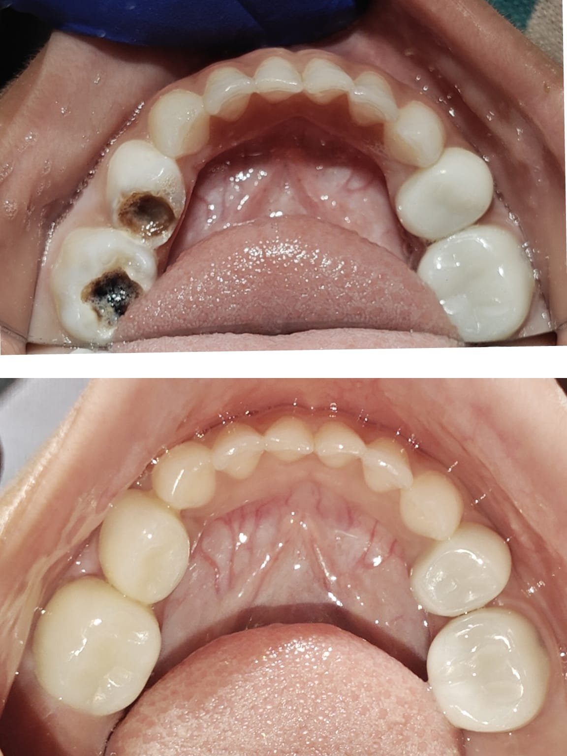 Child dental treatment before and after