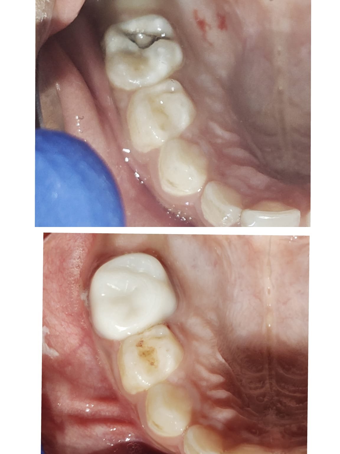 Child dental treatment before and after