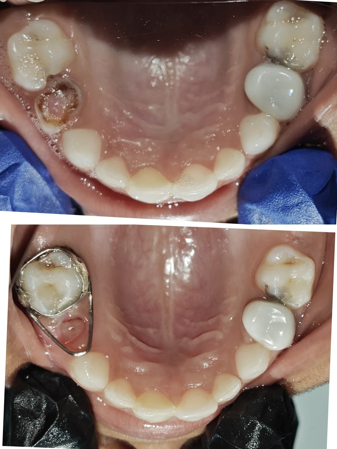 Child dental treatment before and after