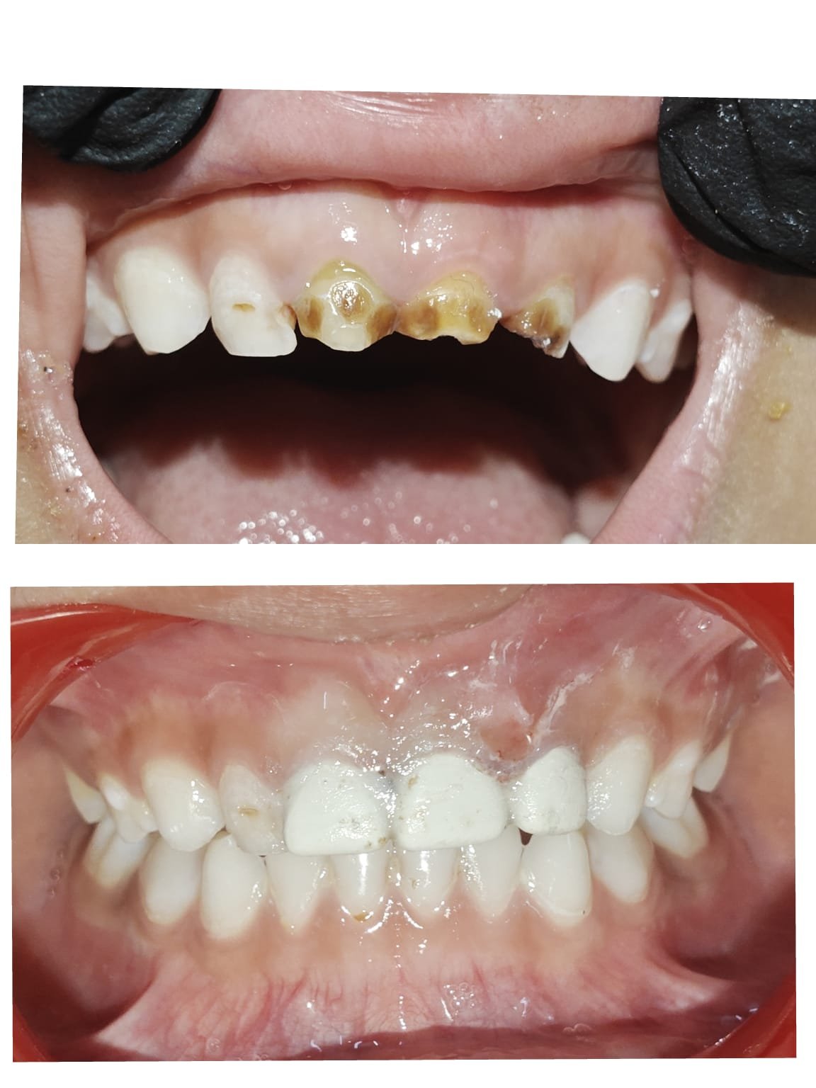 Child dental treatment before and after