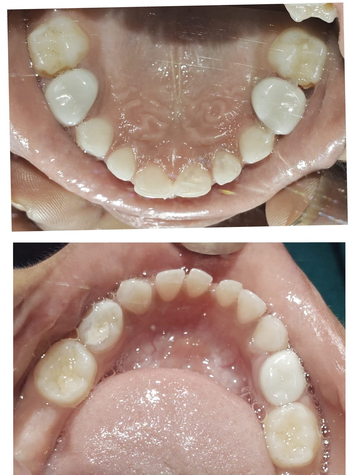 Child dental treatment before and after