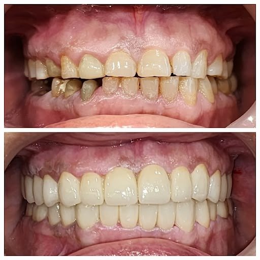 Badly decayed teeth saved with root canals and crowned, not pulled.