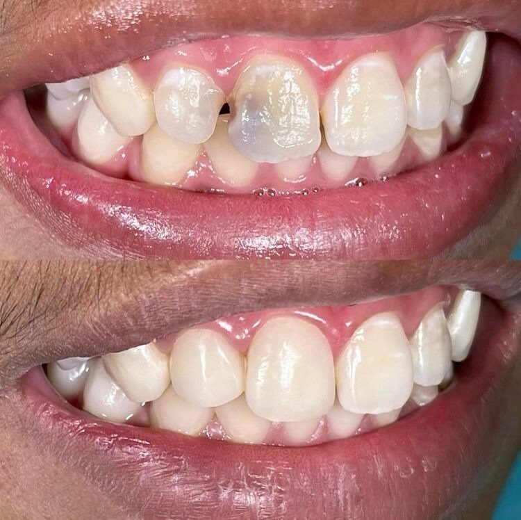 Badly decayed teeth saved with root canals and crowned, not pulled.