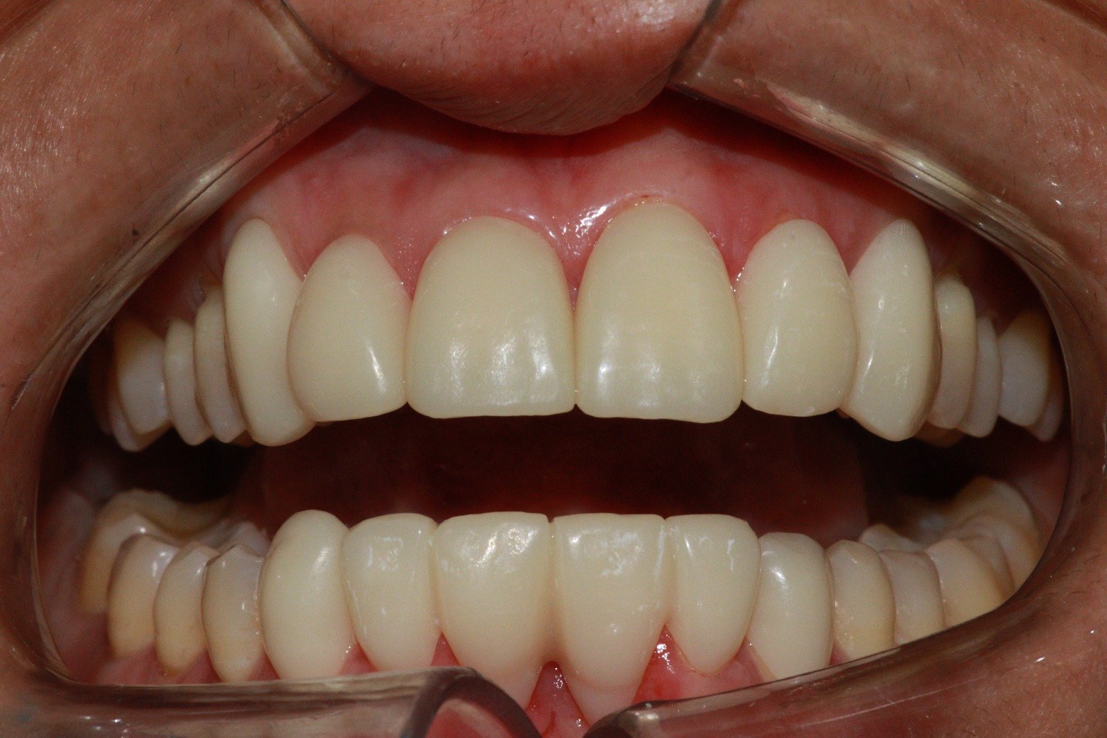 Smile design before and after