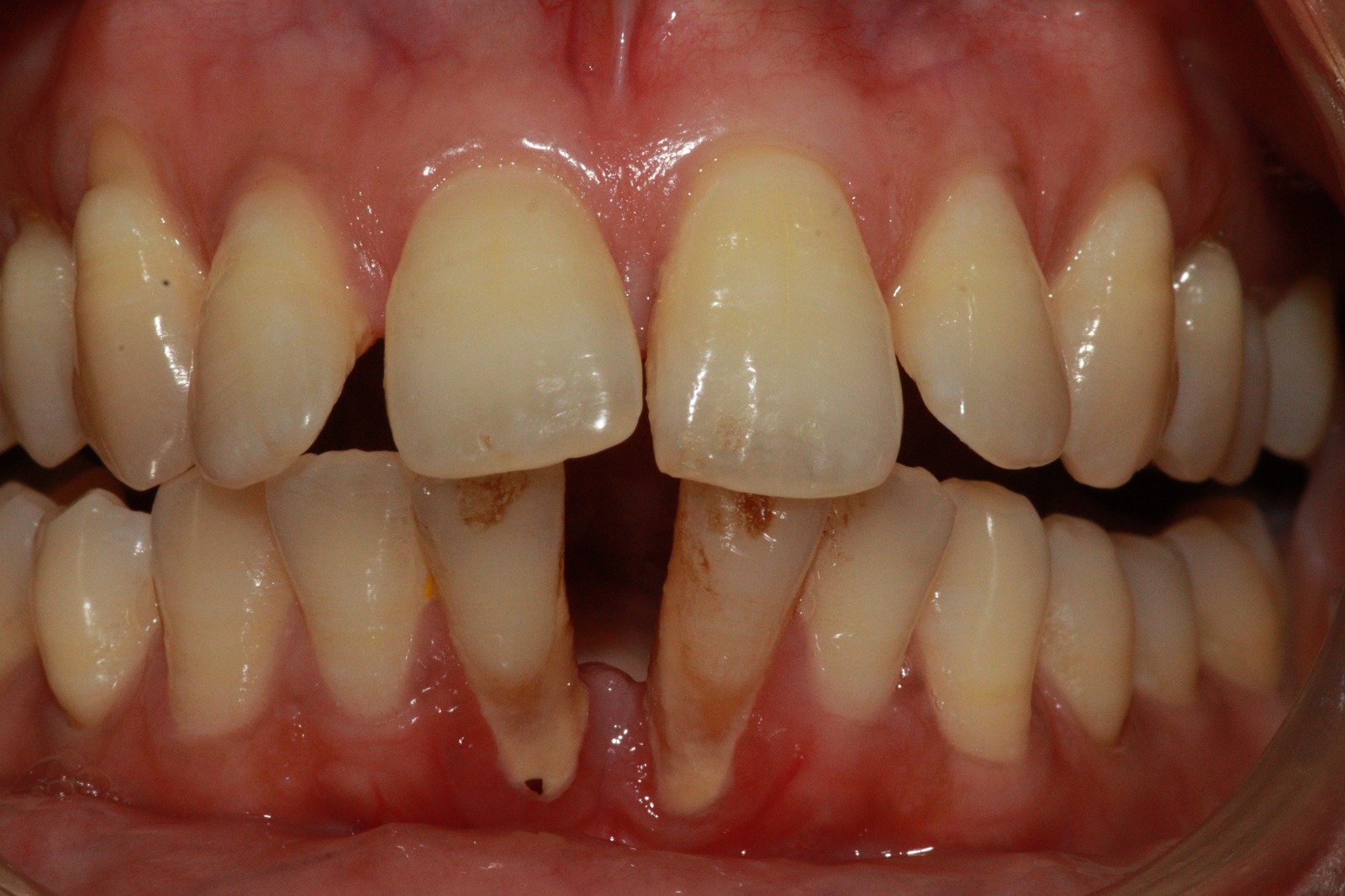 Smile design before and after