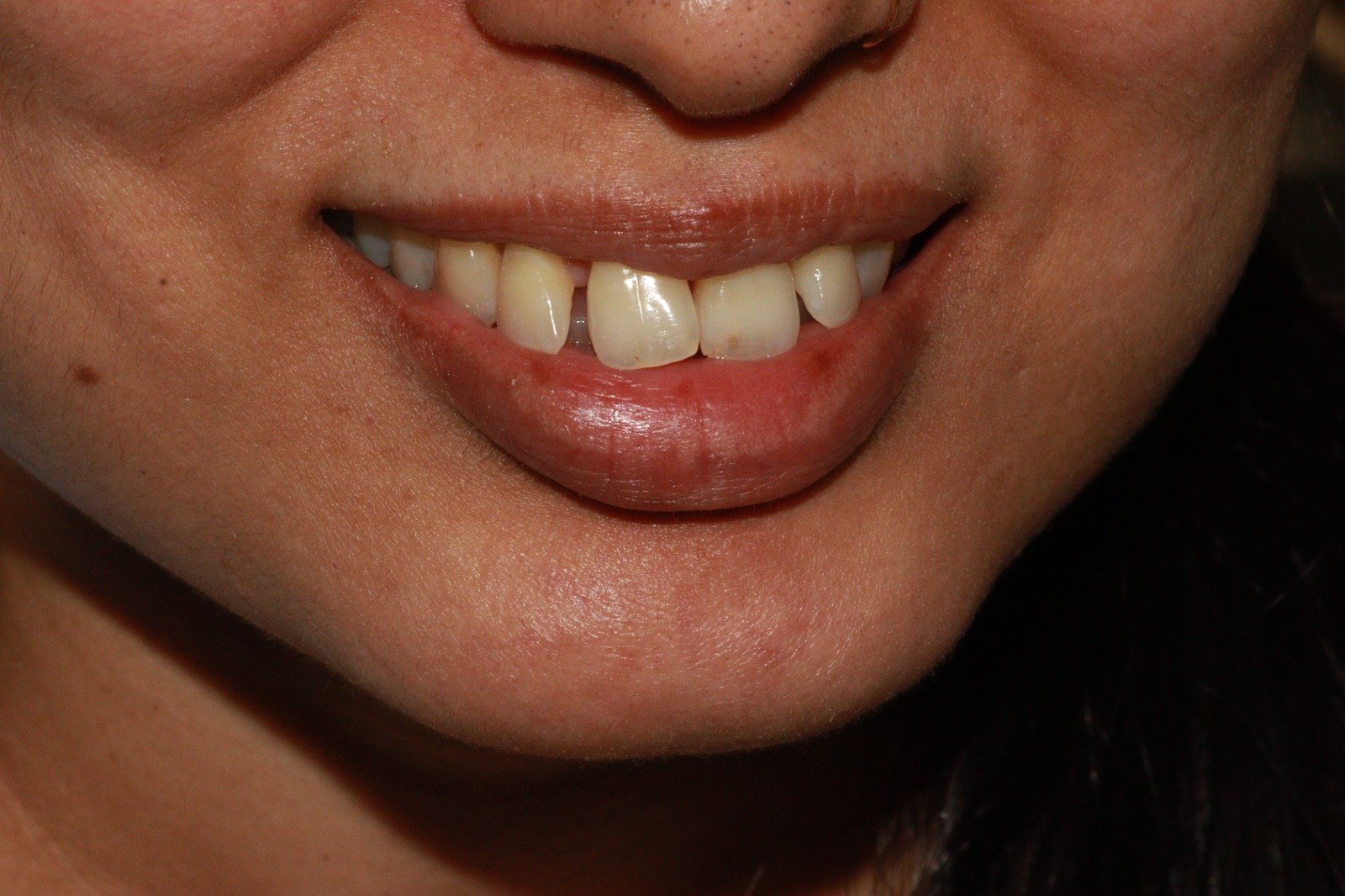 Smile design before and after