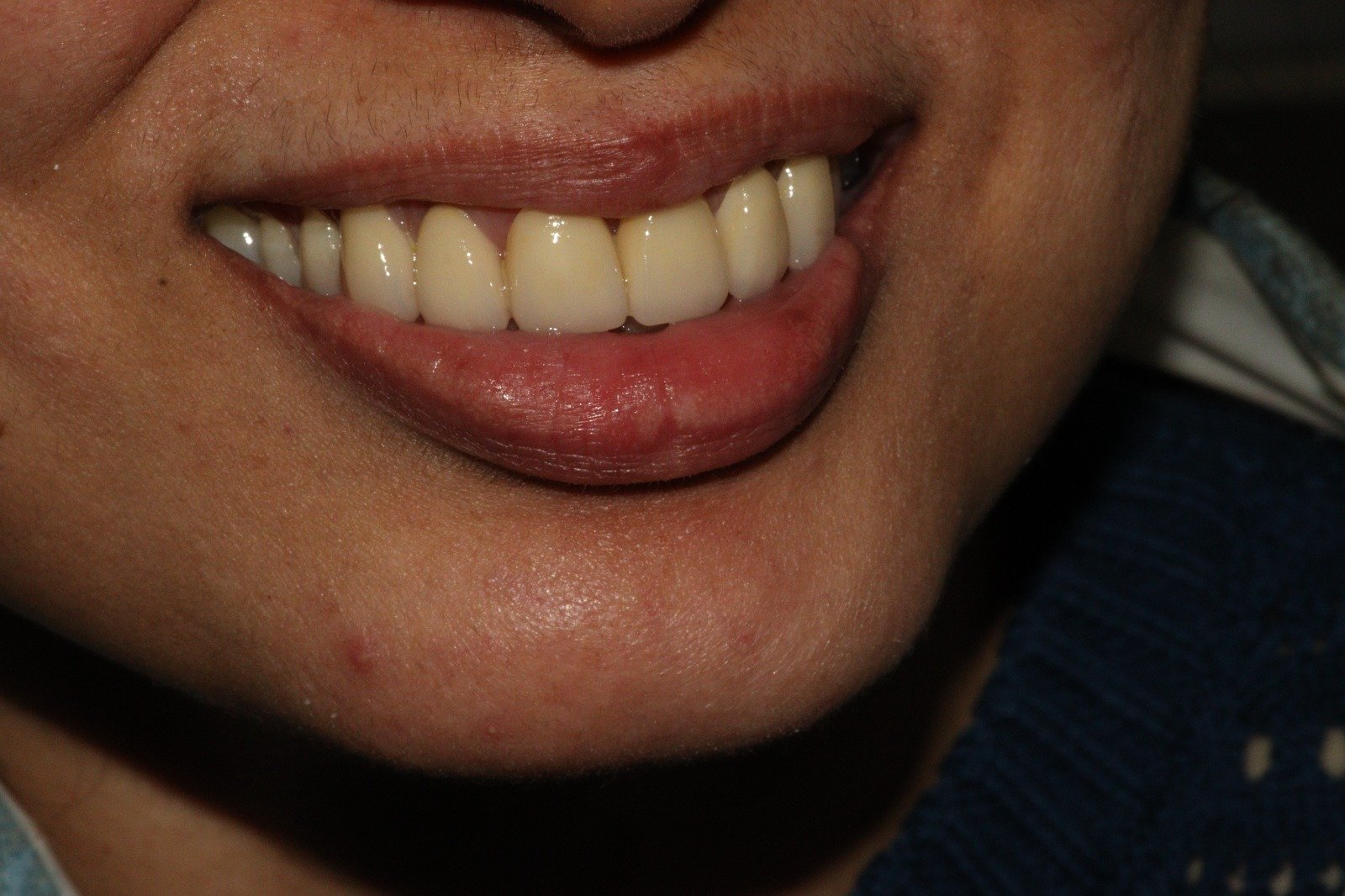 Smile design before and after