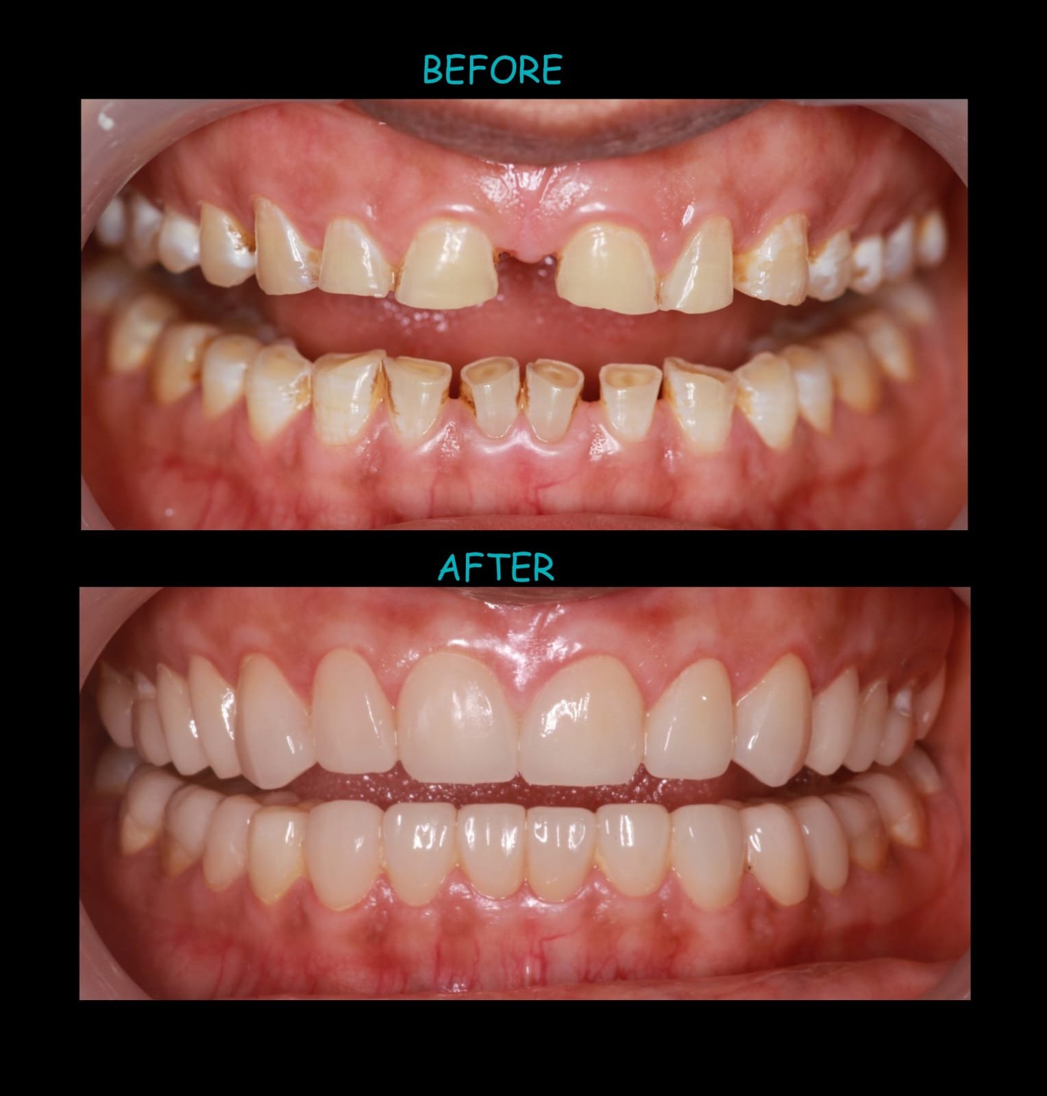Smile design before and after