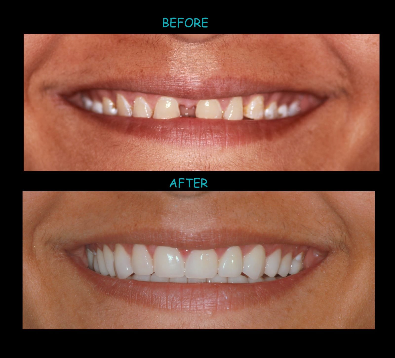 Smile design before and after