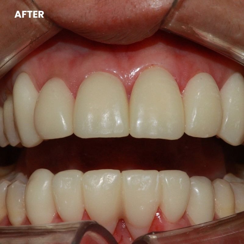 After treatment