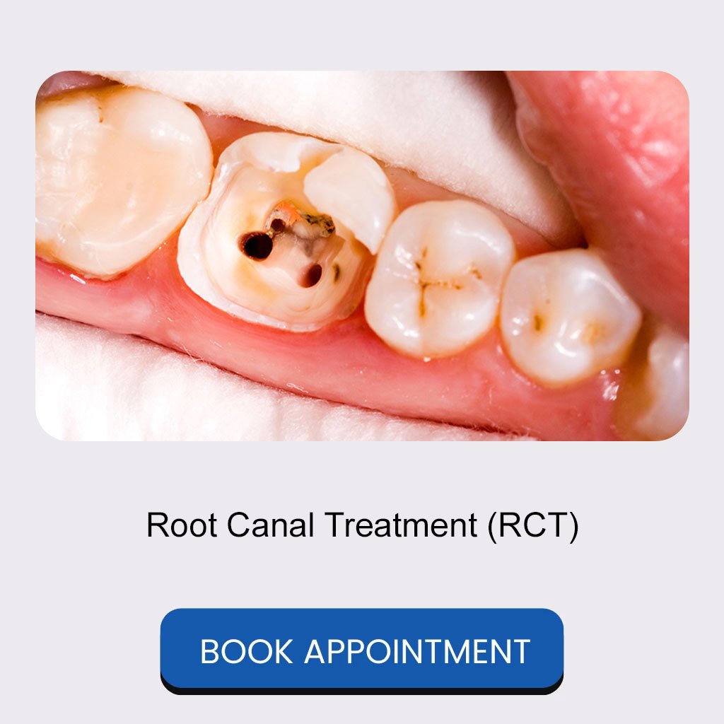 01 Root Canal Treatment (RCT)
