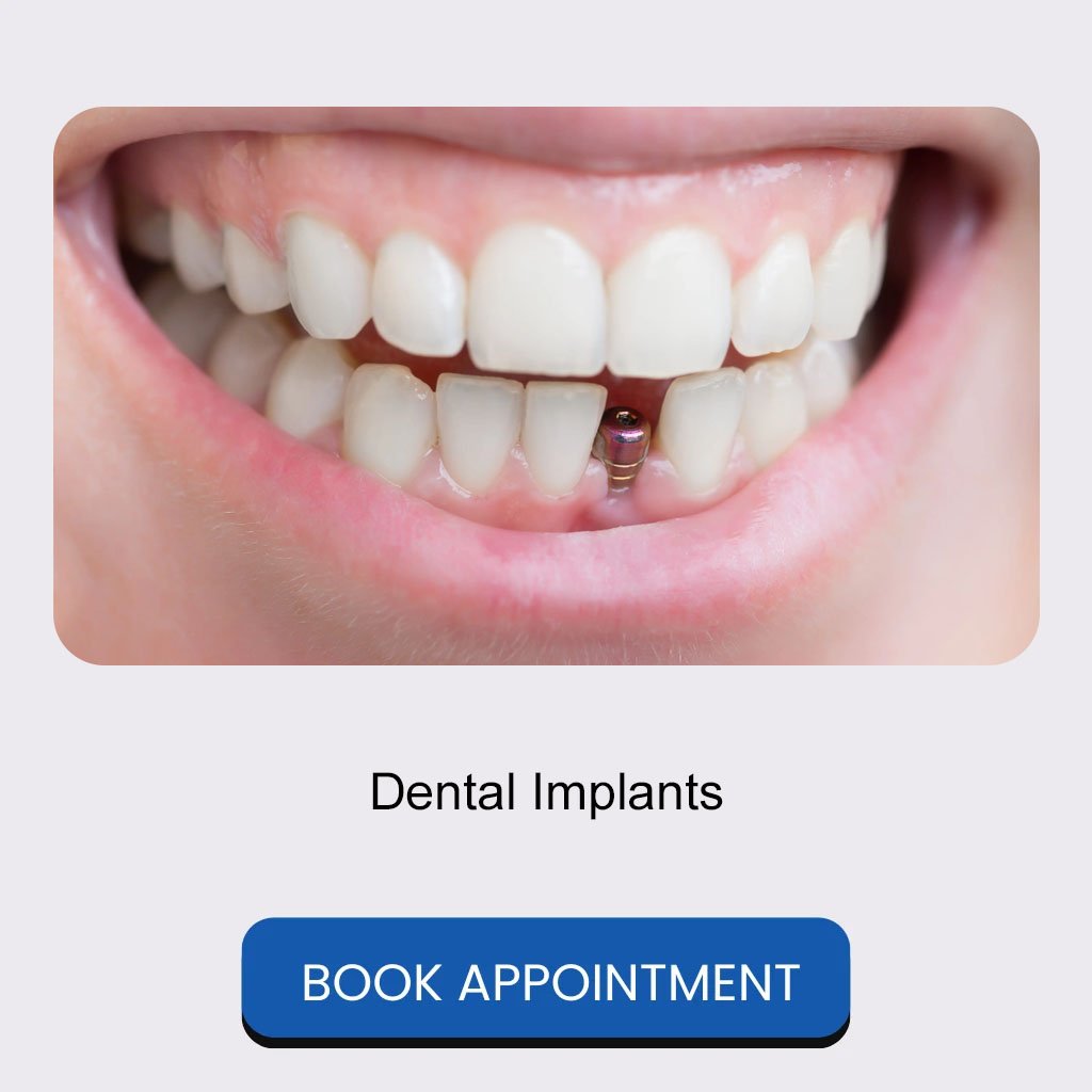 02 Dental Implants